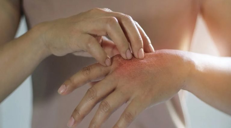 বর্ষার পানি ও ঘাম দুয়ে মিলে বারোটা বাজায় ত্বকের: হতে পারে ফাংগাল ইনফেকশন