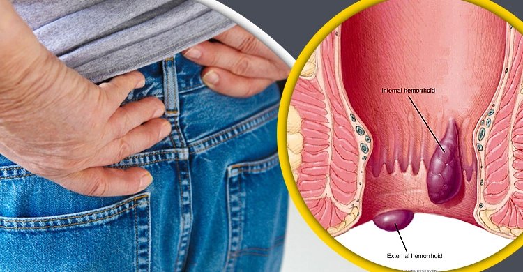 পাইলস কেন হয়? জানুন লক্ষণ ও সমাধানের উপায়