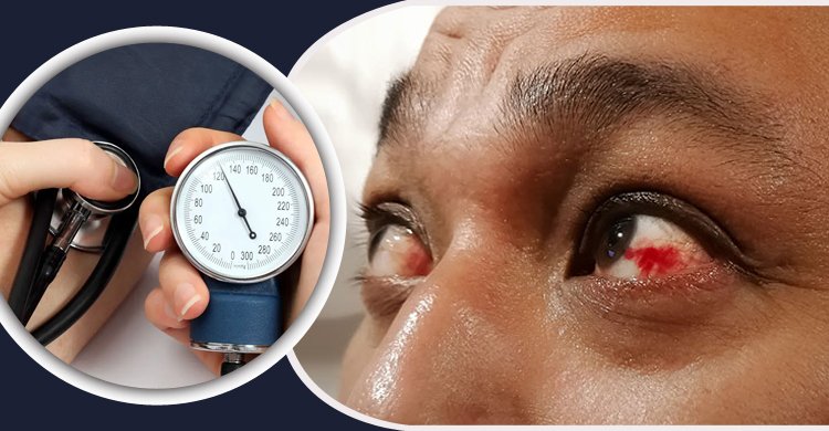 উচ্চ রক্তচাপ নিয়ন্ত্রণে না রাখলে হারাতে পারেন দৃষ্টিশক্তিও