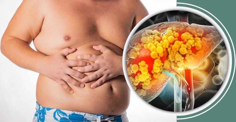 ফ্যাটি লিভারের সমস্যা দূর করার ঘরোয়া উপায়