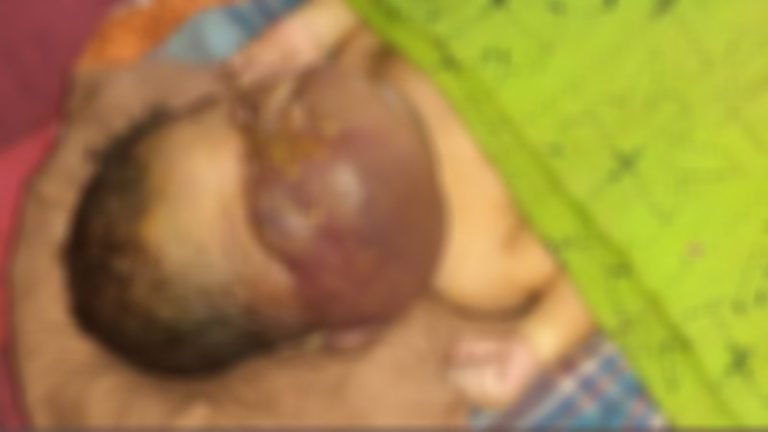 বরগুনায় অদ্ভুত আকৃতির শিশুর জন্ম