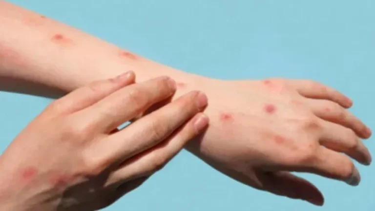 ‘মাঙ্কিপক্স’র প্রকোপ বাড়ছে, কোন লক্ষণ দেখলে সাবধান হবেন?