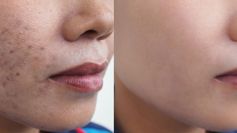 ব্রণের কালো দাগ দূর করতে কী করবেন?