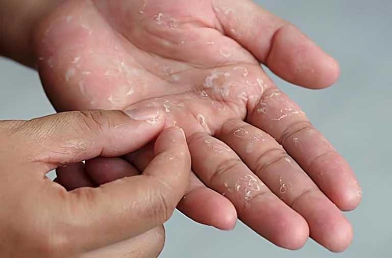 শীতে মুখ ও হাত-পায়ের চামড়া উঠলে কী করবেন?