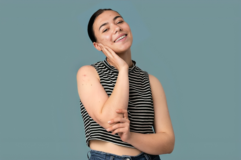 শীতে ত্বকের ব্রণের সমস্যা দূর করার কার্যকর উপায়