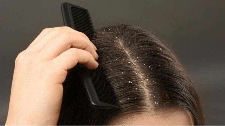 চুলের খুশকি রোধে ঘরোয়া সমাধান: সুস্থ ও পরিষ্কার স্ক্যাল্পের জন্য ৫টি কার্যকর উপায়