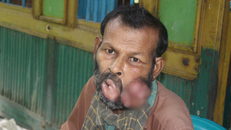 টাকার অভাবে মুখের ক্যানসার নিয়ে মৃত্যুর প্রহর গুনছেন দিনমজুর ফারুক