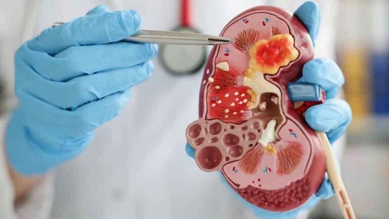 প্রক্রিয়াজাত খাবার বাড়াচ্ছে কিডনি স্টোনের ঝুঁকি