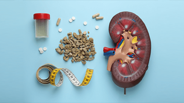 কিডনির পাথর প্রতিরোধে জীবনধারায় সতর্কতা জরুরি