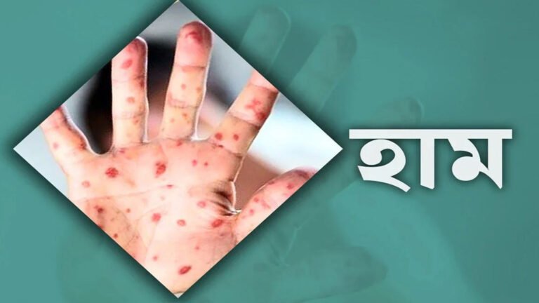 বরিশালে হাম উপসর্গে আরও ২ শিশুর মৃত্যু